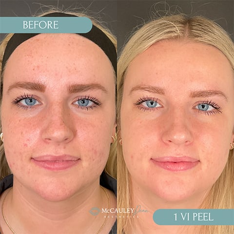 VI Peel Before & After